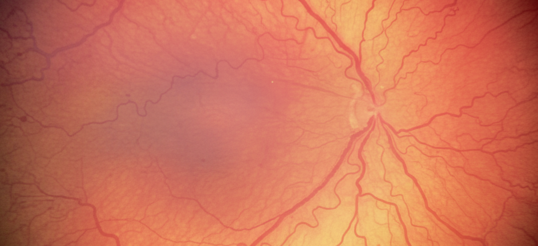 Retinopathy of Prematurity: A Vision Threat in the Tiniest Eyes